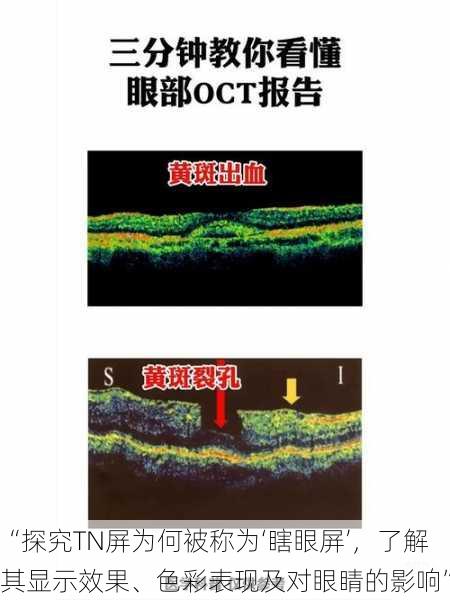 “探究TN屏为何被称为‘瞎眼屏’，了解其显示效果、色彩表现及对眼睛的影响”